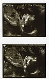 3rd Ultrasound 03